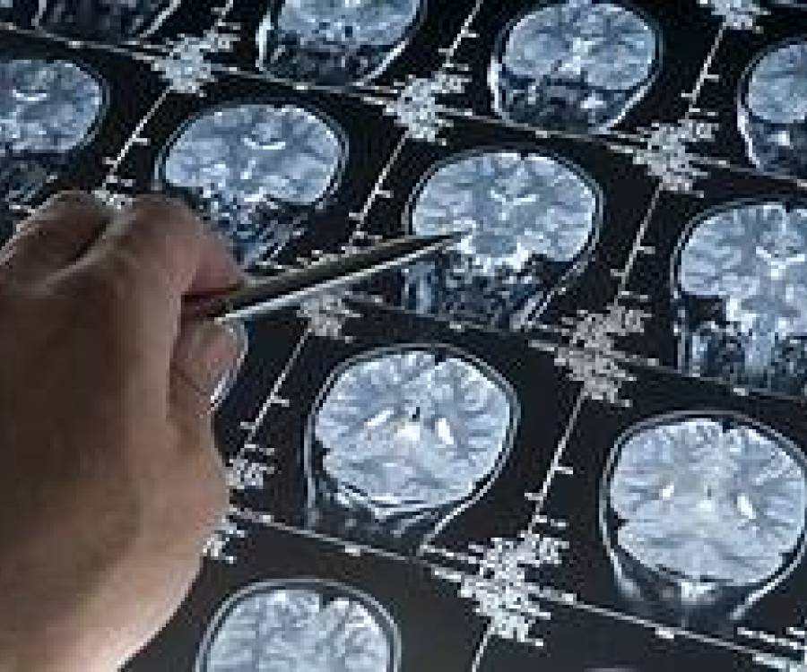 Cómo funciona el nuevo medicamento estrella que ralentiza el avance del Alzheimer